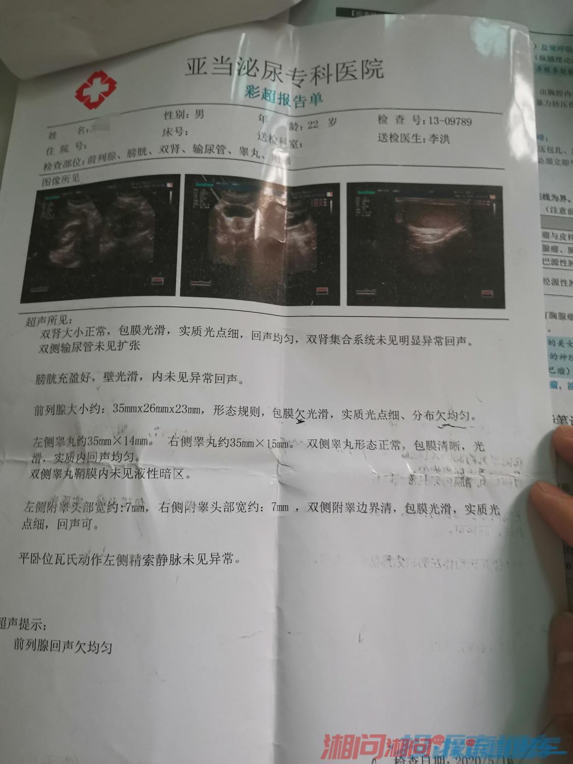前列腺包膜欠光滑,分布欠均匀